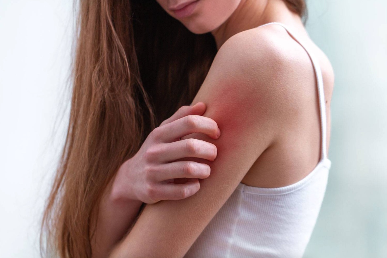 Uyuz Hastalığı: Bulaşma Riskleri ve Korunma Yöntemleri