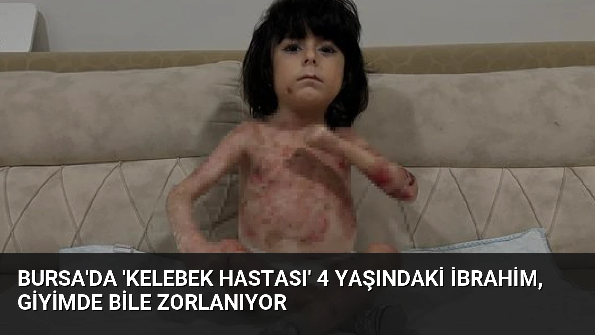 Bursa’da ‘Kelebek Hastası’ 4 Yaşındaki İbrahim, Giyimde Bile Zorlanıyor