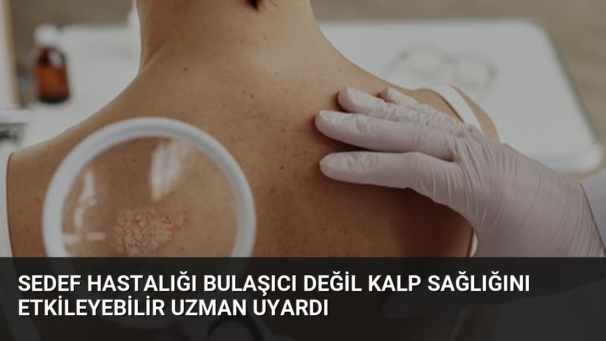 Sedef Hastalığı Bulaşıcı Değil Kalp Sağlığını Etkileyebilir Uzman Uyardı